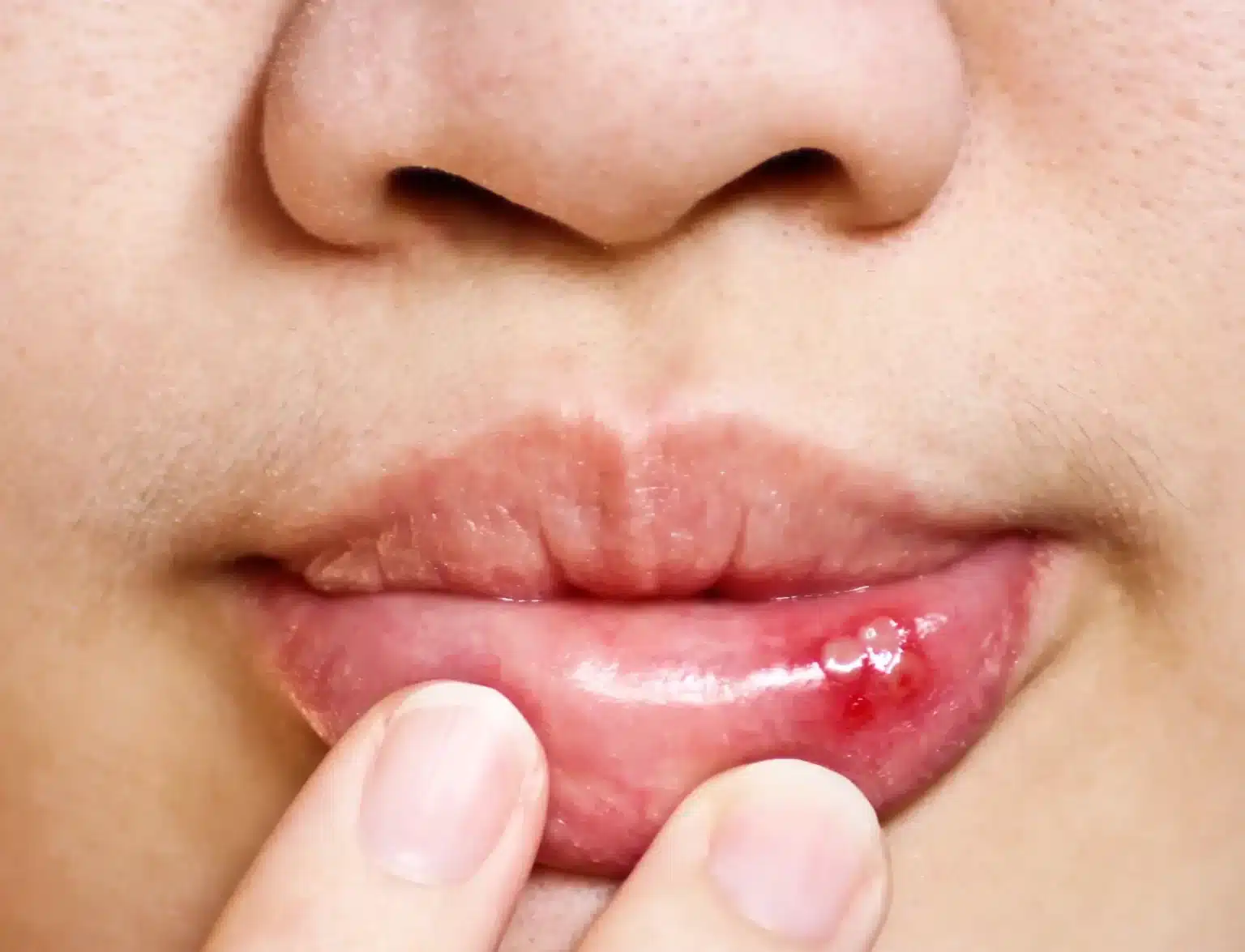 Eine Person mit Lippen-Aphthen.